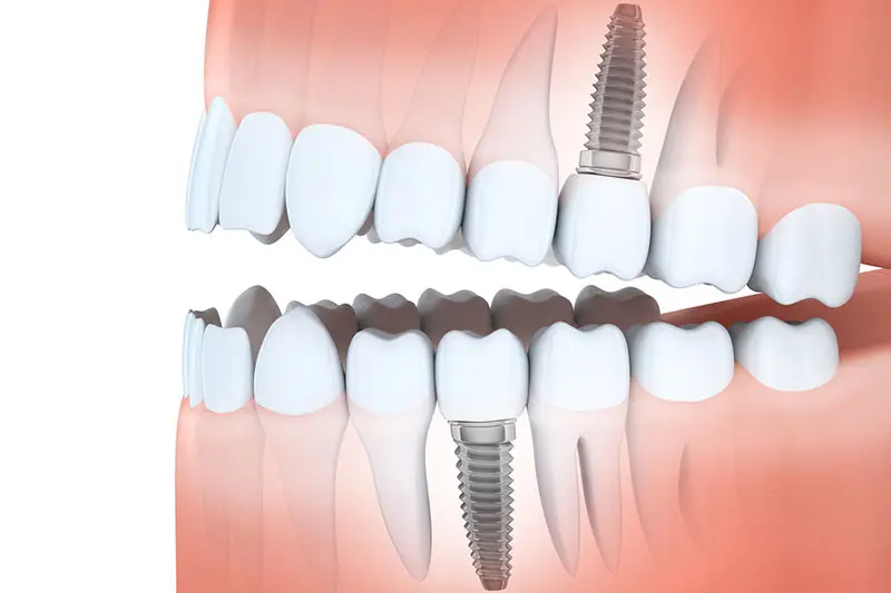 Dental Implants graphic | Pinnacle Oral Surgery Specialist | Rockwall & Sulphur Springs
