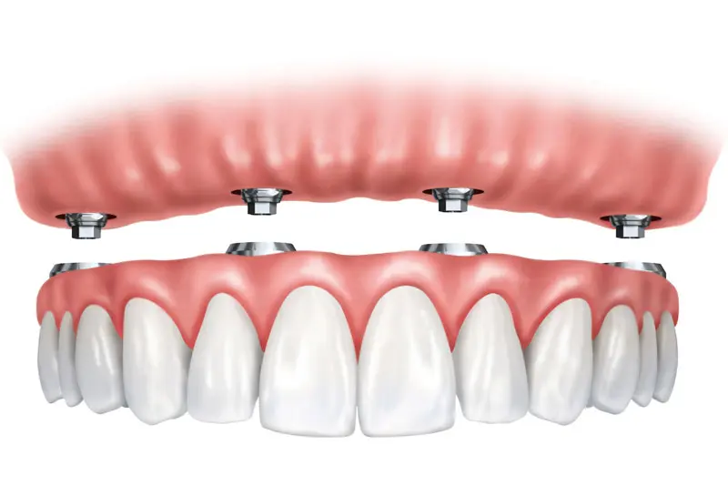 All-on-4 | Teeth In A Day | Pinnacle Oral Surgery Specialist | Rockwall & Sulphur Springs