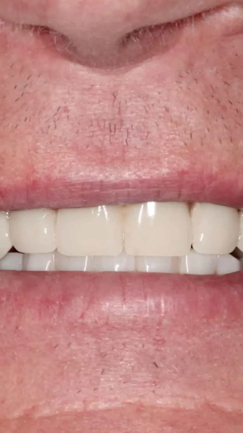 All On X Teeth In A Day Pinnacle Oral Surgery Thumbnail