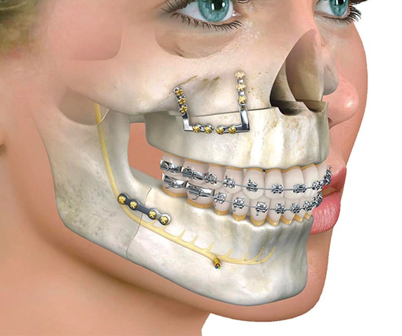 Orthognathic Surgery | Pinnacle Oral Surgery Specialist | Rockwall & Sulphur Springs