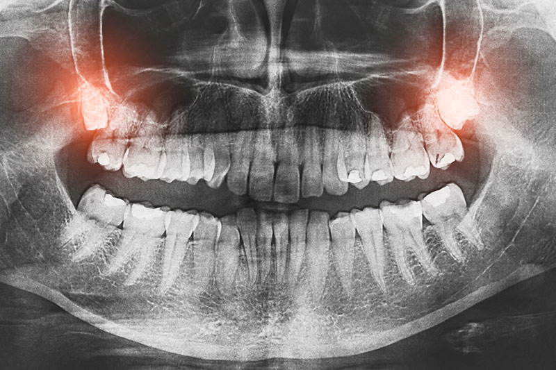 Wisdom Teeth X-Ray | Pinnacle Oral Surgery Specialist | Rockwall & Sulphur Springs
