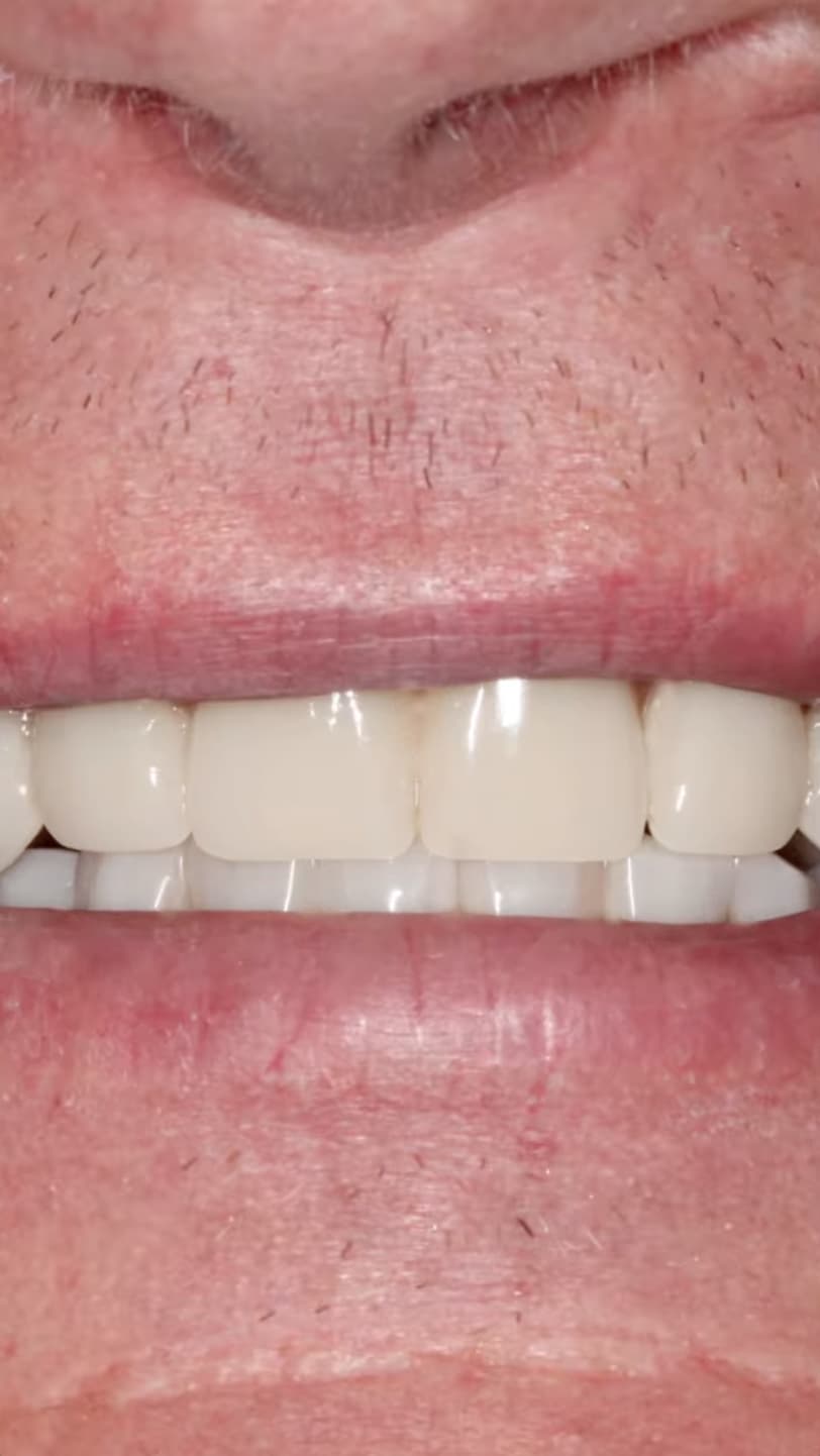 All On X Teeth In A Day Pinnacle Oral Surgery Thumbnail