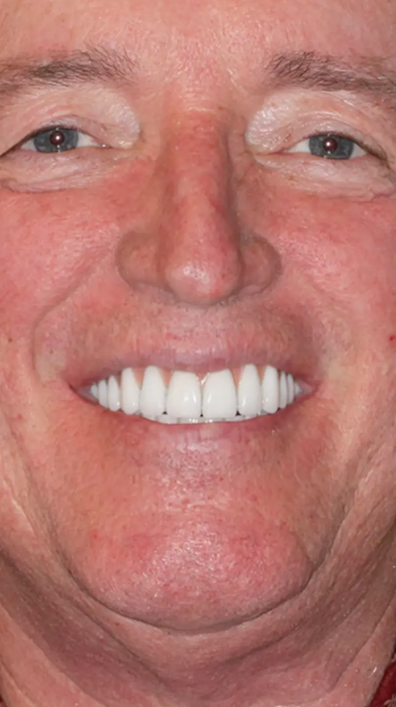 All On X Teeth In A Day Pinnacle Oral Surgery Thumbnail