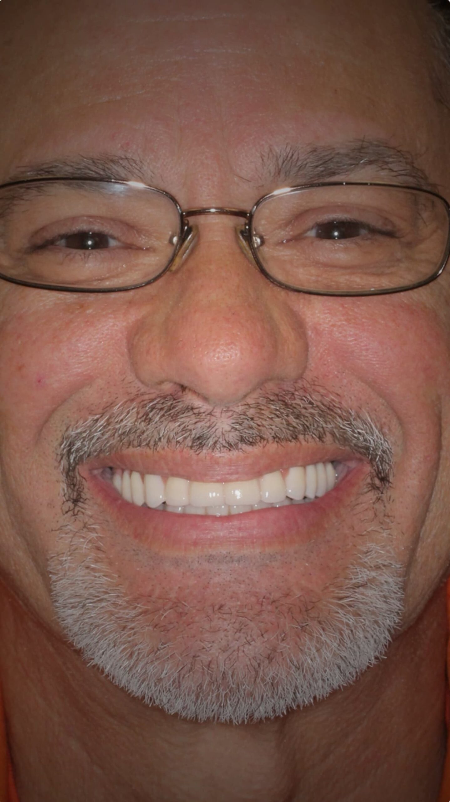 All On X Teeth In A Day Pinnacle Oral Surgery Thumbnail