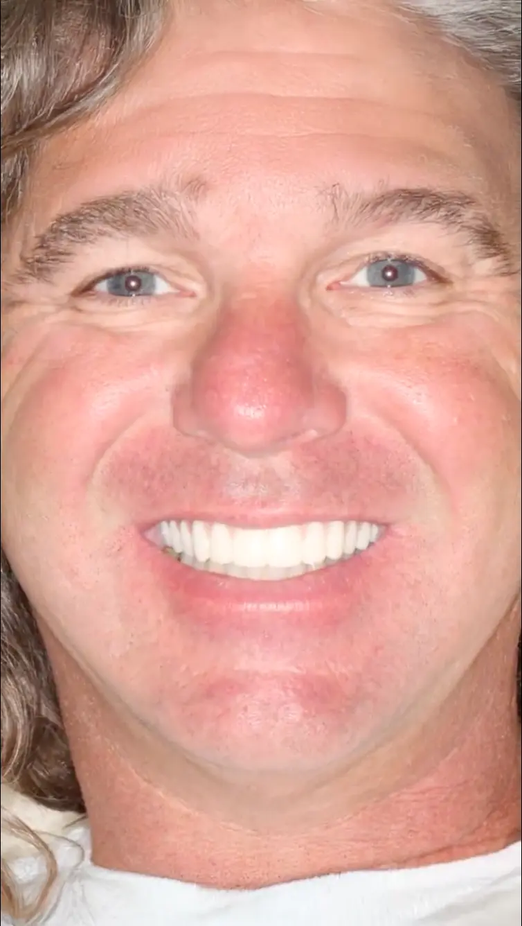 All On X Teeth In A Day Pinnacle Oral Surgery Thumbnail