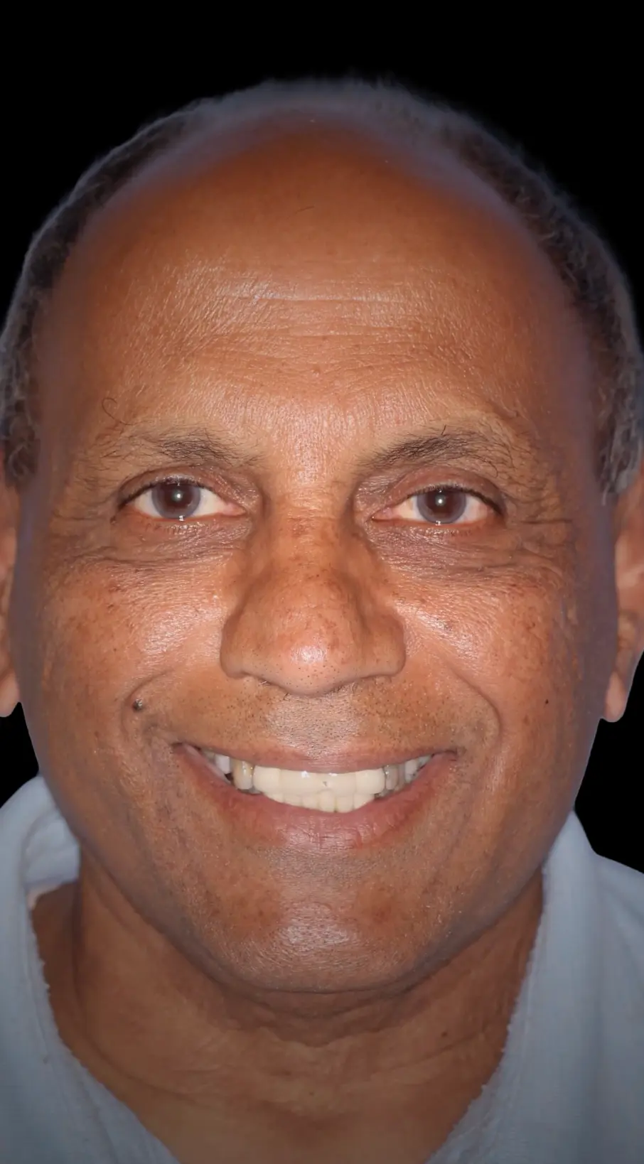 All On X | Teeth In A Day Case 3 | Pinnacle Oral Surgery