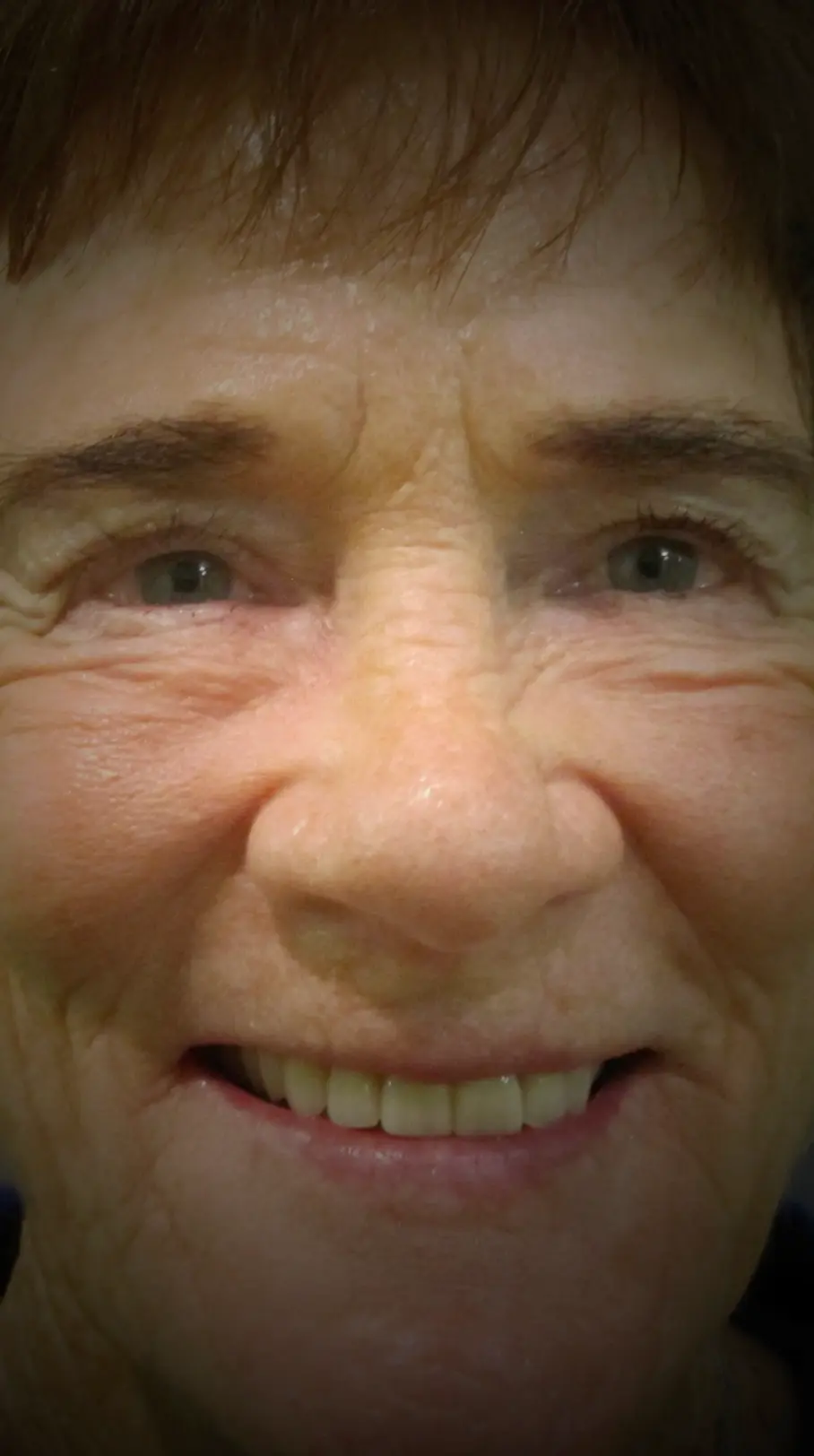 All On X | Teeth In A Day Case 4 | Pinnacle Oral Surgery