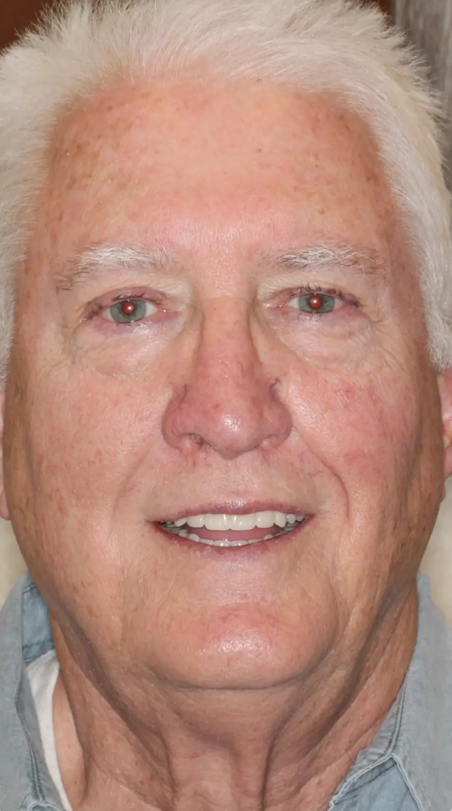 All On X | Teeth In A Day Case AOX4 | Pinnacle Oral Surgery