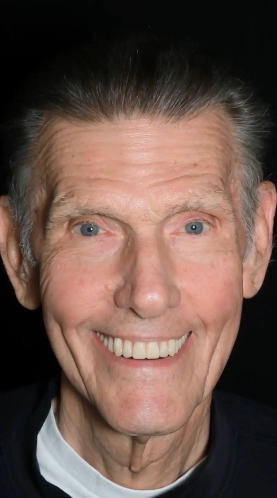 All On X | Teeth In A Day Case KM | Pinnacle Oral Surgery