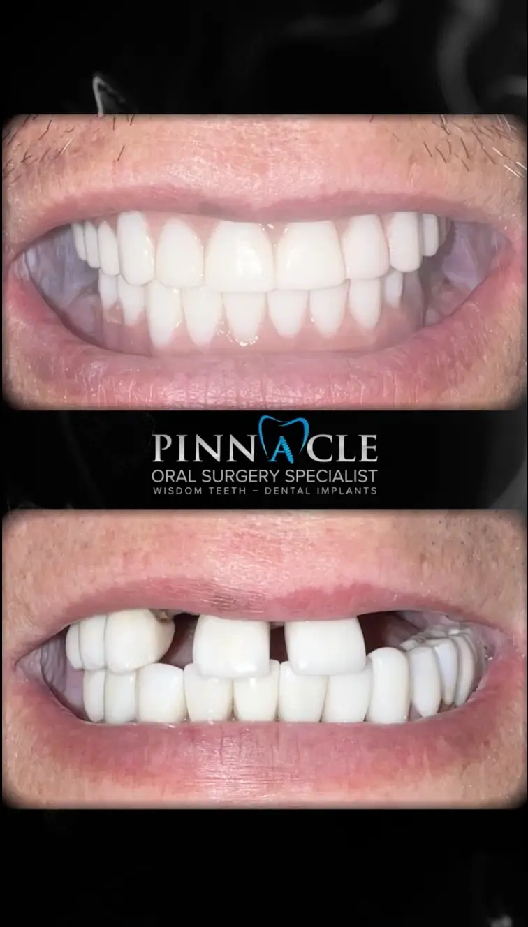 All On X | Teeth In A Day Case 9 | Pinnacle Oral Surgery