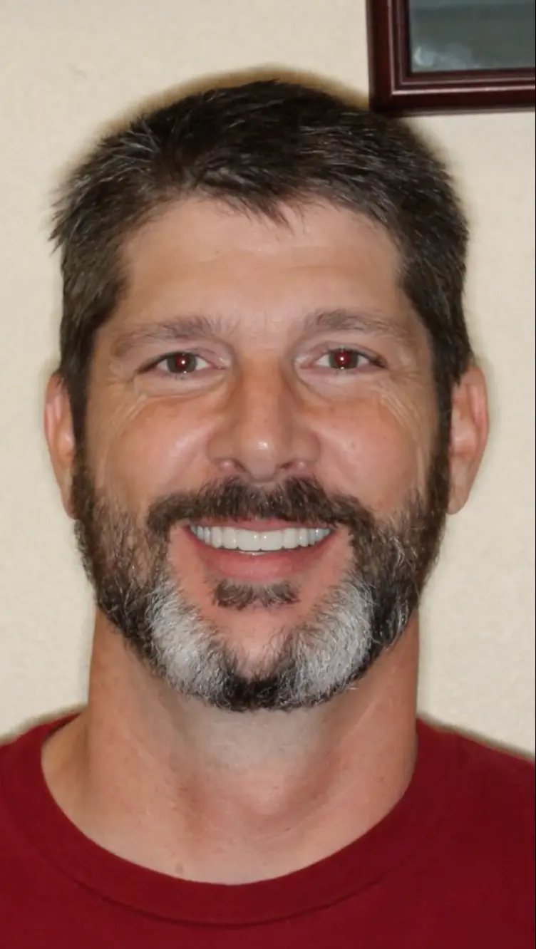 All On X | Teeth In A Day Case SD | Pinnacle Oral Surgery