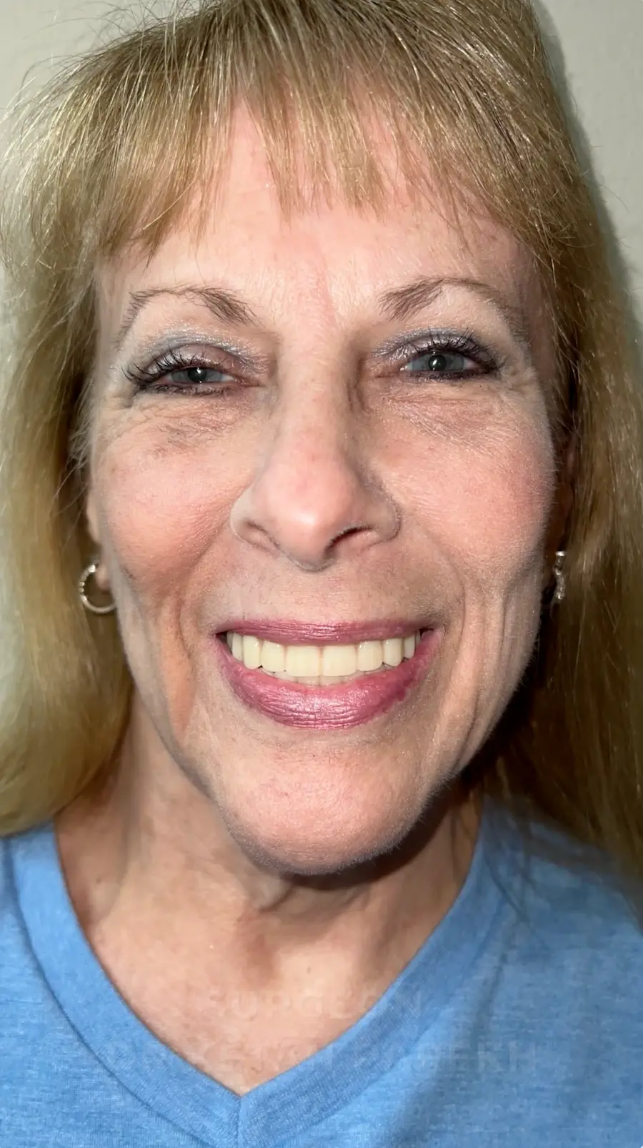 All On X | Teeth In A Day 3rd Video | Pinnacle Oral Surgery