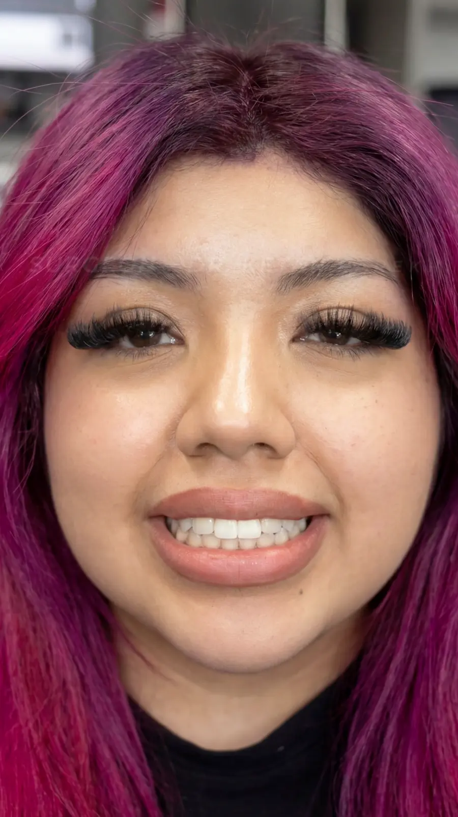 All On X | Teeth In A Day Case JH | Pinnacle Oral Surgery