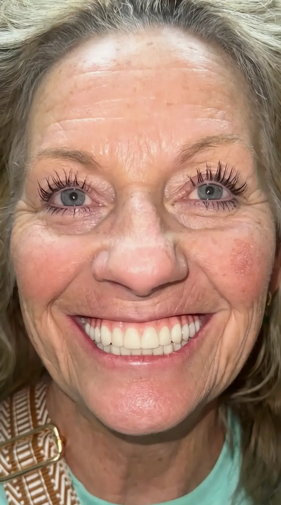 All On X | Teeth In A Day Reel 10 | Pinnacle Oral Surgery