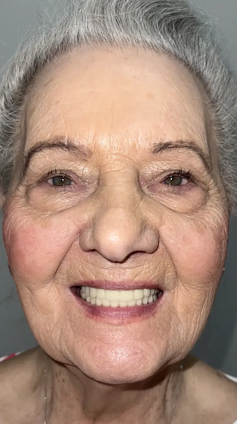 All On X | Teeth In A Day Reel 14 | Pinnacle Oral Surgery