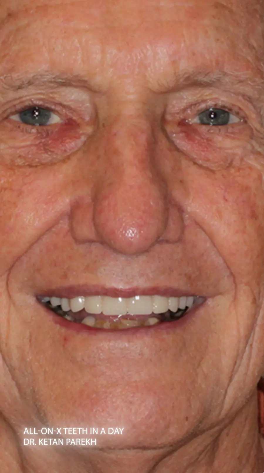 All On X | Teeth In A Day img7144 | Pinnacle Oral Surgery