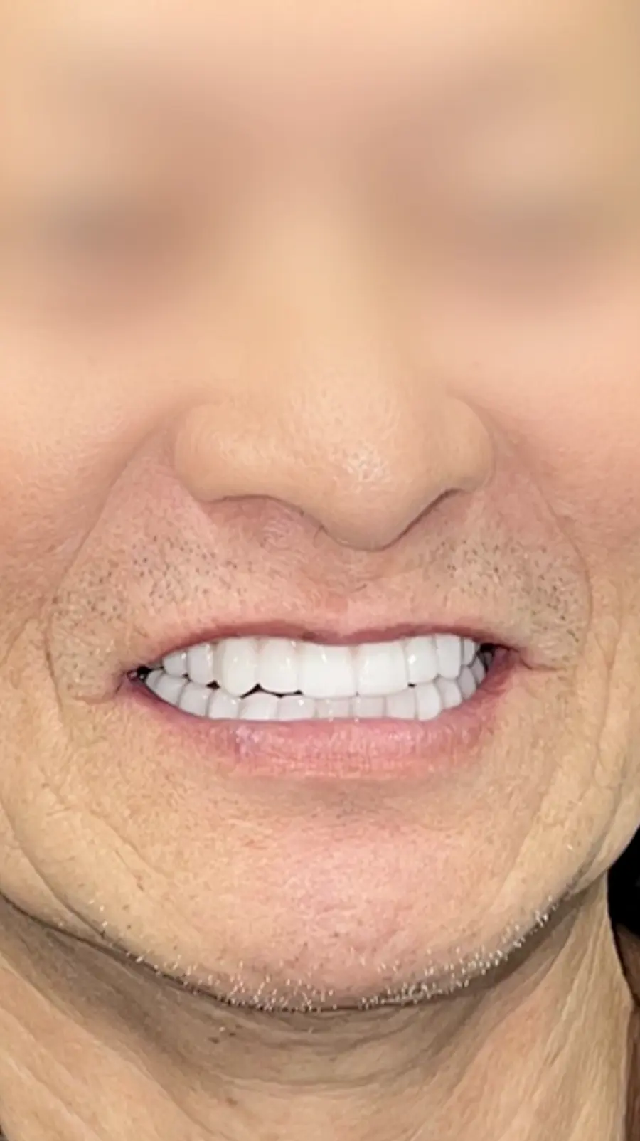 All On X_Case 20260628_Pinnacle Oral Surgery