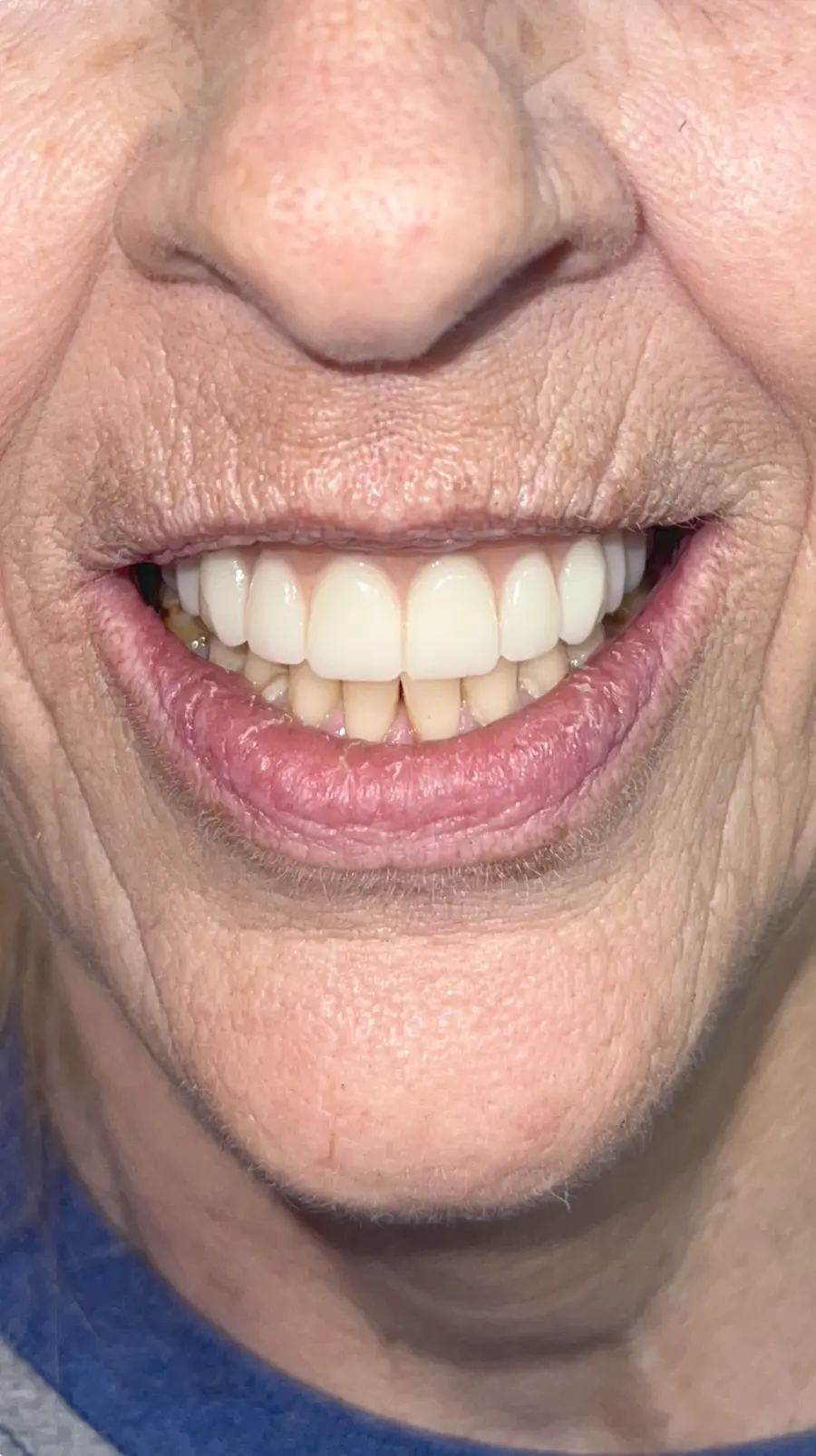 All On X_Case CD_Pinnacle Oral Surgery