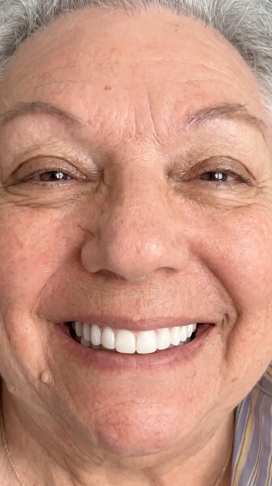All On X_Case EB_Reel 26_Pinnacle Oral Surgery